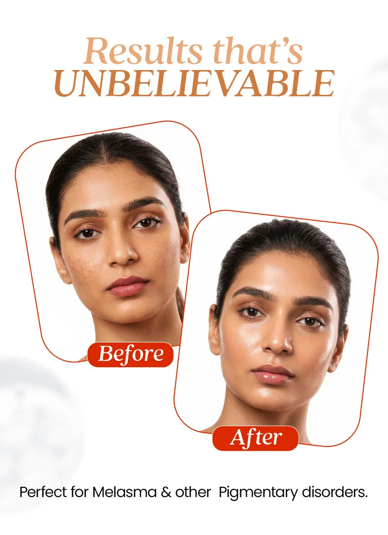 Before and after comparison of a woman's face with text 'Results that's UNBELIEVABLE' and 'Perfect for Melasma & other Pigmentary disorders.'.