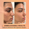 Load image into Gallery viewer, 2% Kojic Acid Face Serum for Skin Brightening, Dark Spot Correcting & Radiant Glow 30ml
