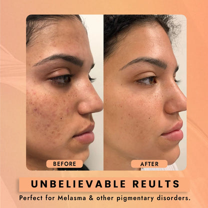 2% Kojic Acid Face Serum for Brightening & Dark Spot Care – 30ml