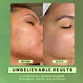 Load image into Gallery viewer, 2% Salicylic Acid Face Serum | Anti-Acne Serum for Oil-Control, Clear & Balanced Skin 30ml
