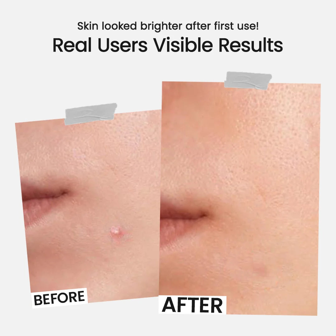 Overnight Acne Pimple Patch | 36 Dots