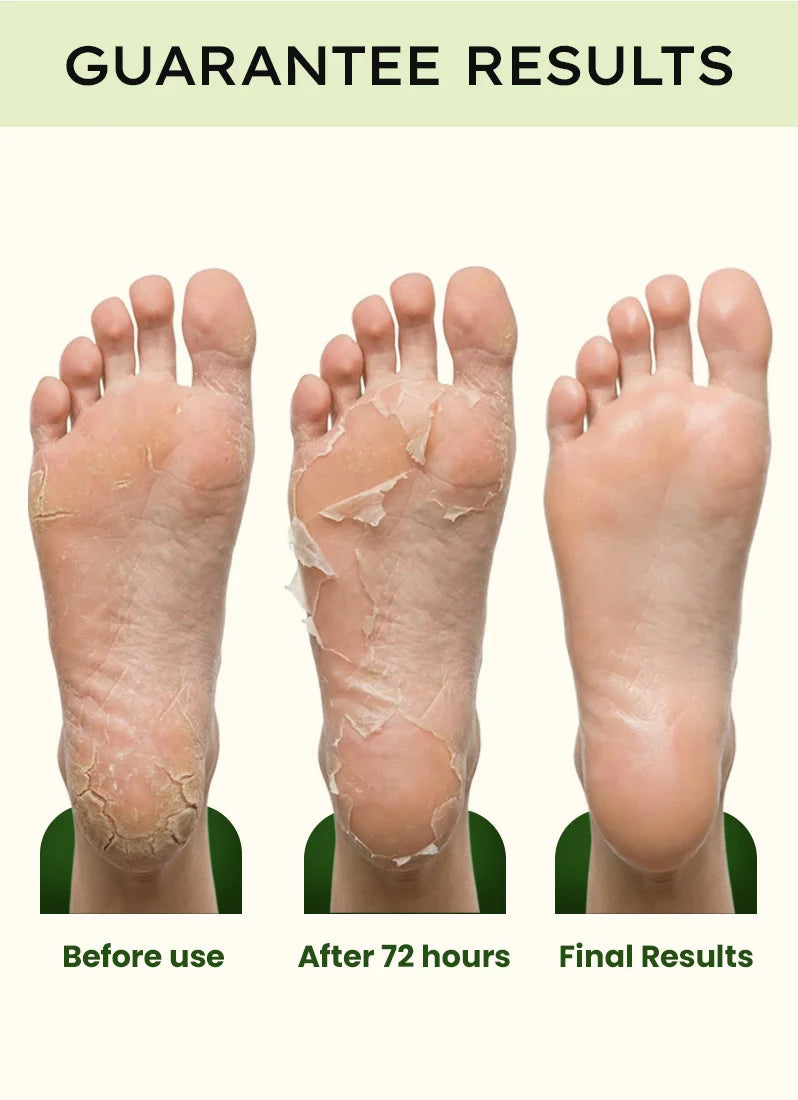 Before and after foot treatment results showing peeling skin on a green background.
