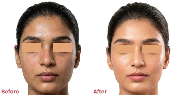 Before and after comparison of a woman's face with blurring over eyes.