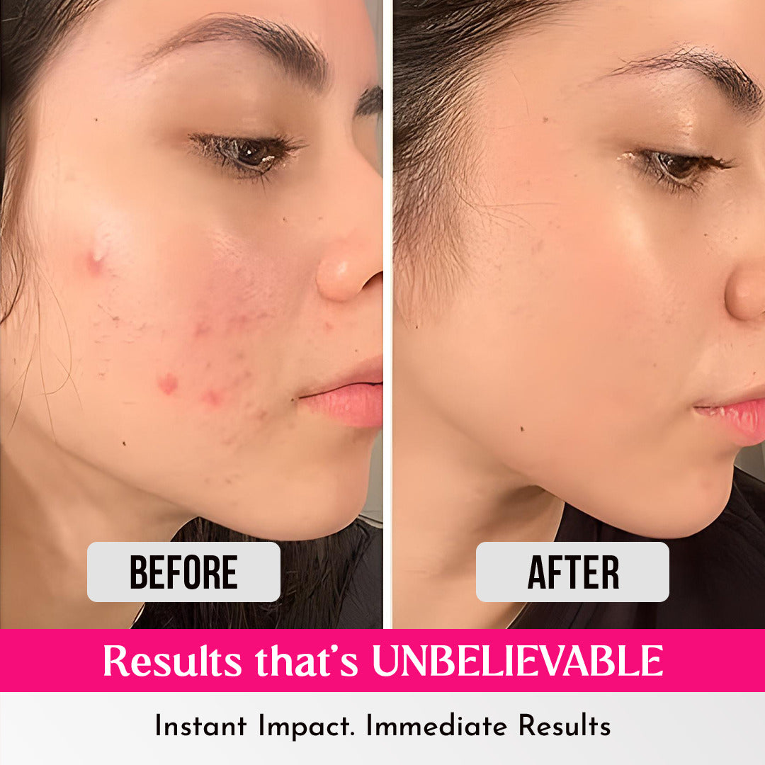 Overnight Acne Pimple Patches with Salicylic Acid – 36 Dots