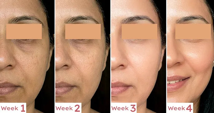 Before and after skincare treatment comparison over 4 weeks on a person's face.
