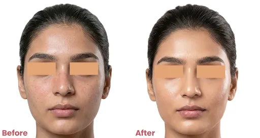 Before and after comparison of a woman's face with cosmetic patches over eyes.